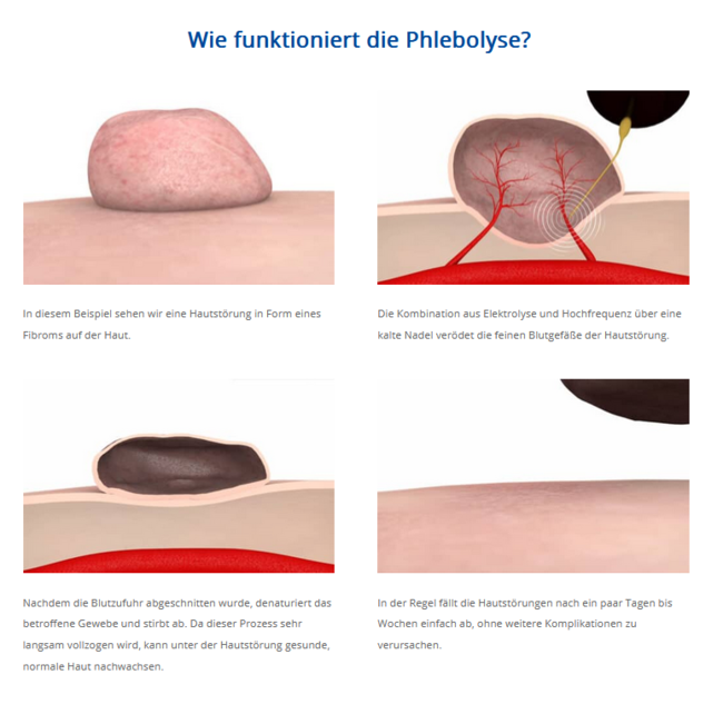 Wie funktioniert die Phlebolyse?